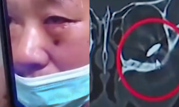 The Nanjinger - 3cm Nail Removed from Man’s Eye after 3 Days