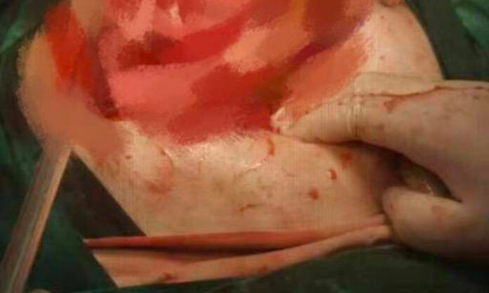 The Nanjinger - Woman in Changzhou gets Successful Operation for 1,000+ Lumps in Abdomen