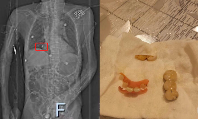 The Nanjinger - 80 Year Old Chokes to Death on Own Teeth; Hospital Questioned