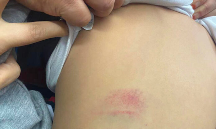 The Nanjinger - Taizhou Teacher’s Beating Leaves 7 Year Old Boy Battered & Bruised