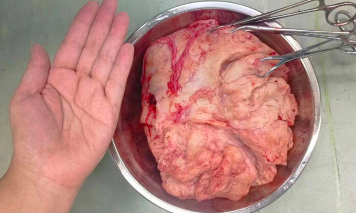 The Nanjinger - 17 YO thought She was Pregnant; was Fibroids Size of Volleyball