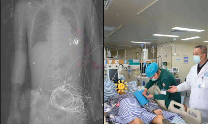 The Nanjinger - World’s Smallest Artificial Heart Implanted into 20 Year Old by Huai’an Doctors