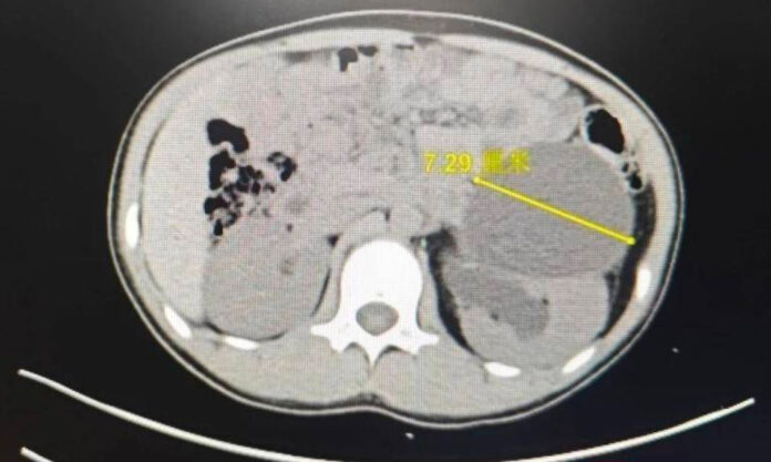 The Nanjinger - 13 Ureters; Teenage Girl’s Physical Mystery in Lianyungang Finally Solved