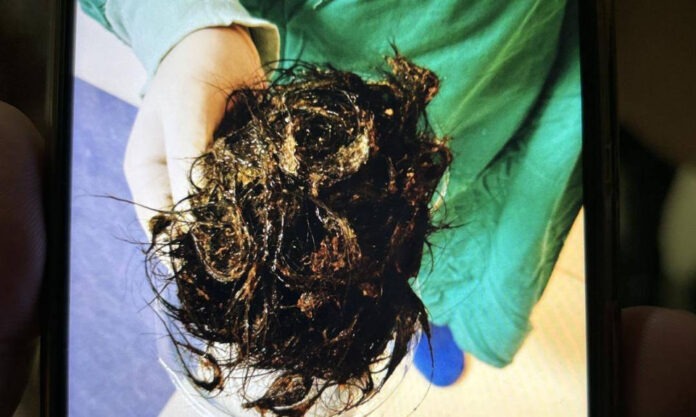 The Nanjinger - 11 Year Old Girl in Suqian Found to have Stomach Full of Hair