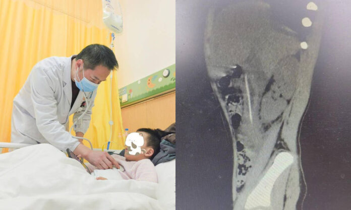 The Nanjinger - 4 Year Old Swallows Toothpick; Changzhou Boy with Intestinal Perforation