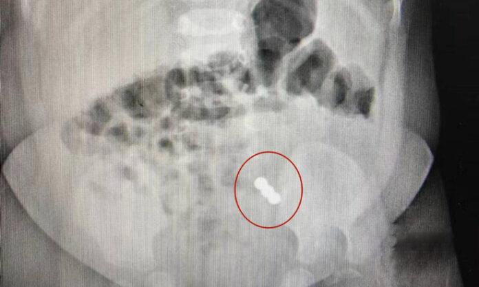 The Nanjinger - 8 Month Old Baby Boy in Huai’an Ingests Beads, Fortunately Magnetic