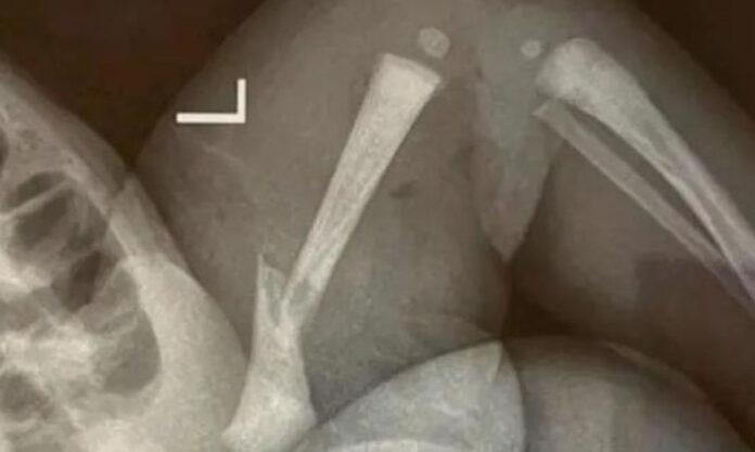 The Nanjinger - Newborn with Fractured Leg Result of Medical Malpractice by Hospital in Taizhou