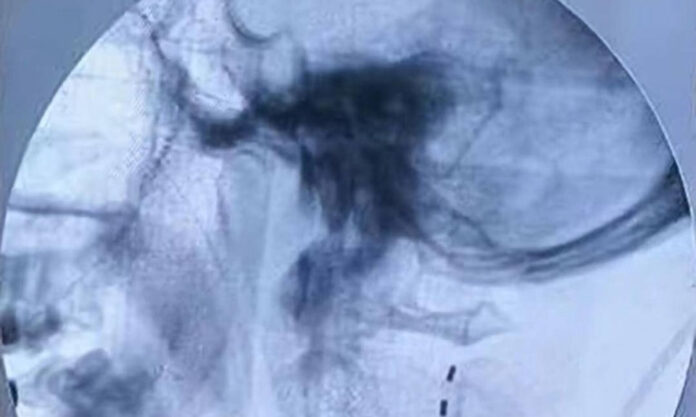 The Nanjinger - Nanjing Doctors Wake Patient from Coma using Spinal Cord Stimulation