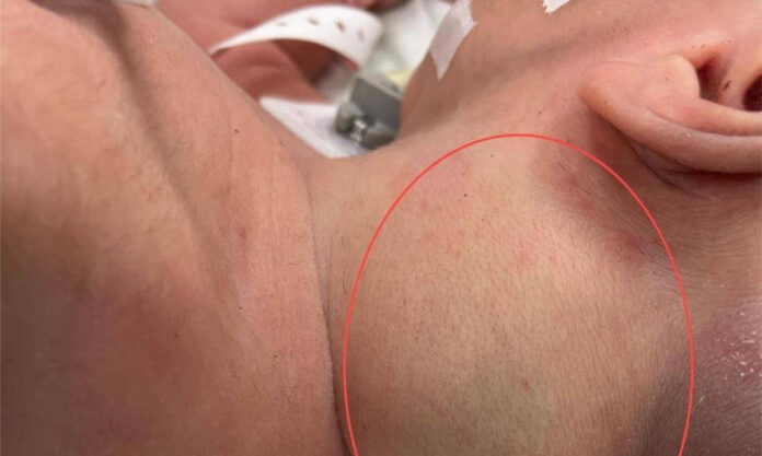 The Nanjinger - Saved! 3 Day Old Baby in Huai’an Born with 5CM Tumour in Neck