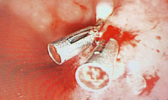 The Nanjinger - 70 Year Old Zhenjiang Woman’s Husband Uses Chopsticks to Relieve her Constipation