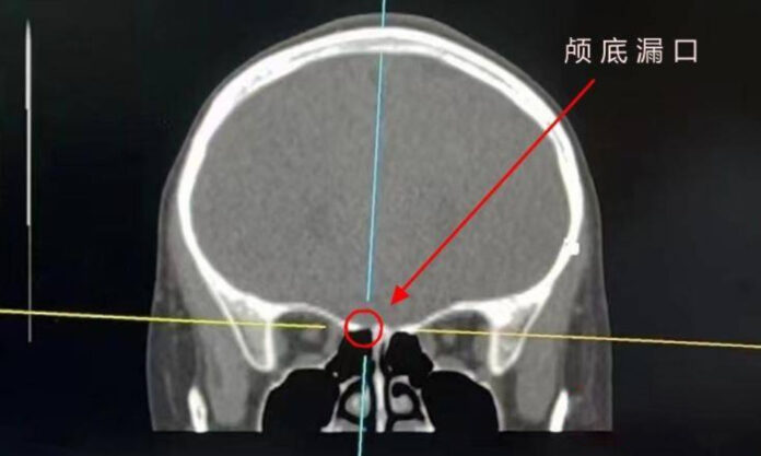 The Nanjinger - 9YO Girl in Nanjing with Skull Base Defect Discharges Spinal Fluid from Nose