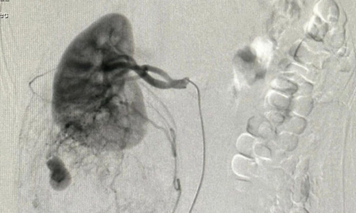The Nanjinger - Life Threatening Massage! Stressed out Changzhou Woman Suffers Renal Hamartoma