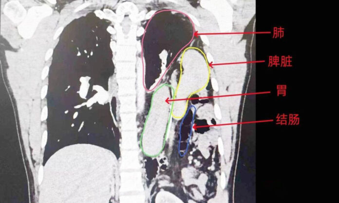 The Nanjinger - Lianyungang Man’s Spleen, Stomach & Colon Herniate into Chest Cavity