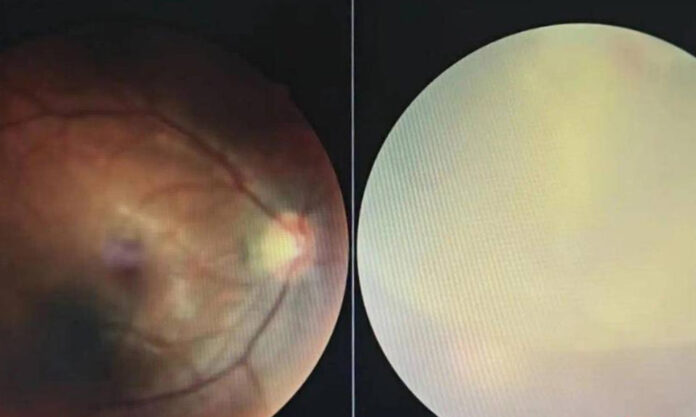 The Nanjinger - Yangzhou Man Blind in Left Eye after Straining to Defecate; Recovery Expected
